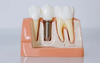 歯科修復における磁器炉の役割