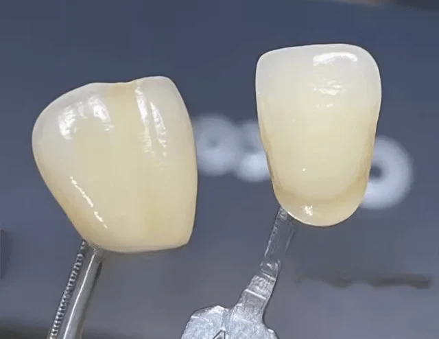 치과 용광로에서 소결된 도자기 치아