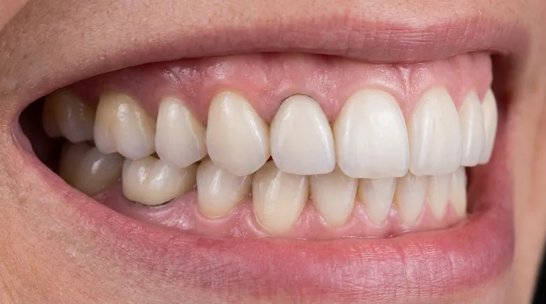 هل يمكن أن تتصبغ الأسنان الخزفية؟ لماذا تقاوم خزفيات الأسنان عالية الجودة تغير اللون